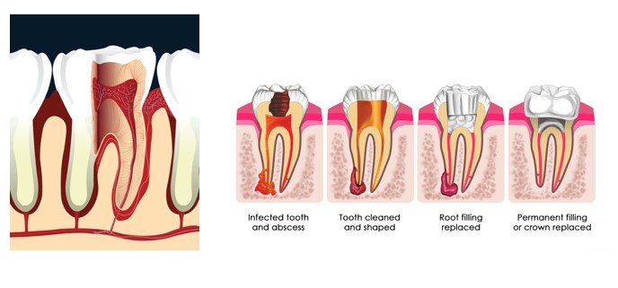 An image showing teeth at different stages of root canal therapy