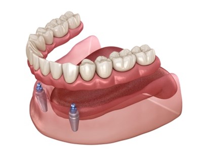 A diagram of a retained denture